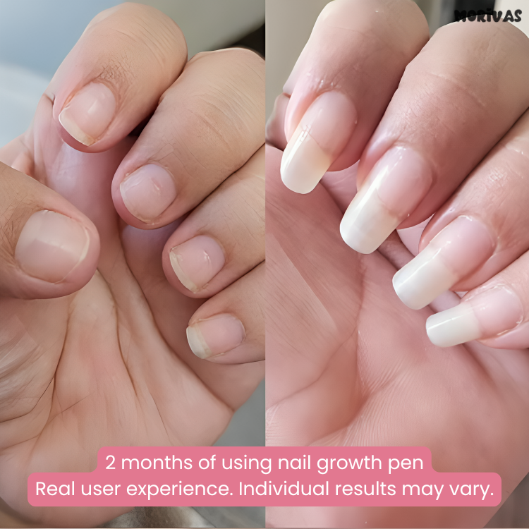 Morivas™ Nail Growth Pen - Grow Strong, Smooth, Beautiful Nails