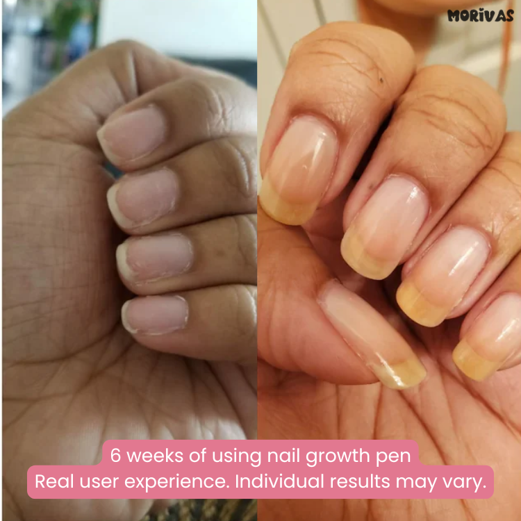 Morivas™ Nail Growth Pen - Grow Strong, Smooth, Beautiful Nails