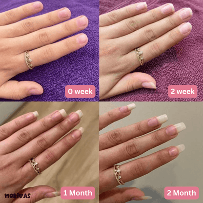 Morivas™ Nail Growth Pen - Grow Strong, Smooth, Beautiful Nails