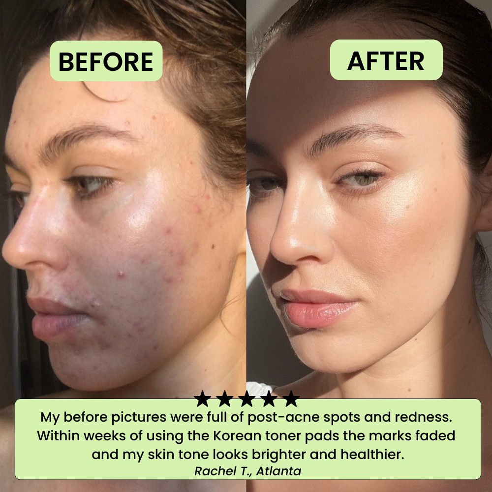 The Korean Toner Pads – Fade Dark Spots & Hyperpigmentation Fast
